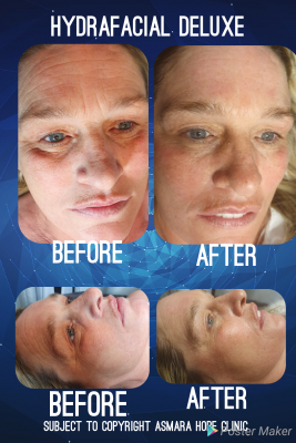 <img scr="woman_with_hydrafacial.png" alt="woman with hydrafacial"