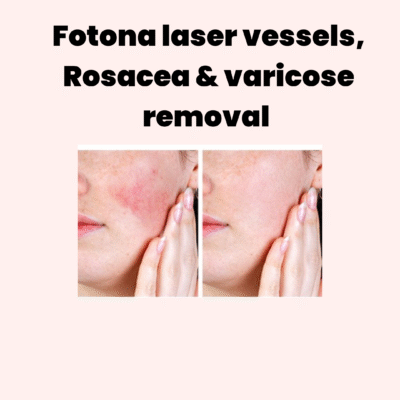 <img laser=“image.jpg” alt=“image treatment ” title=“image rosacea ”>