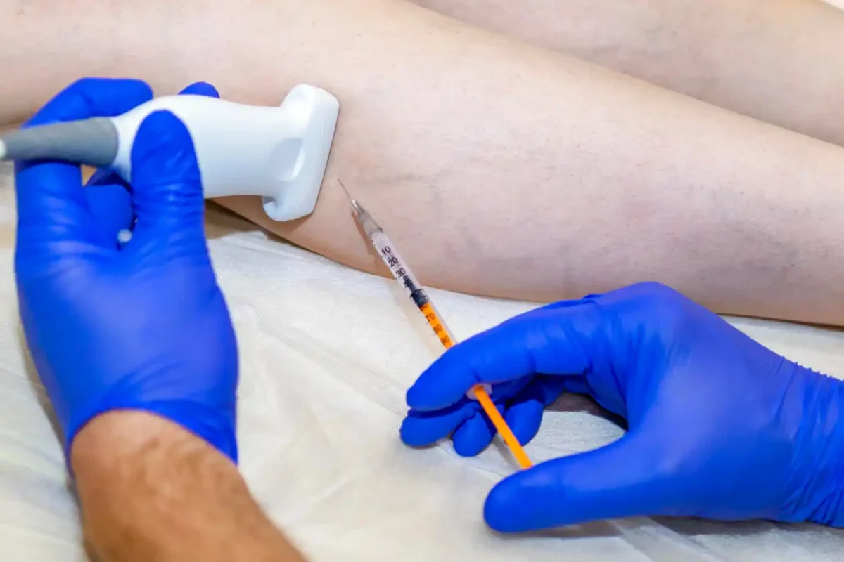 Laser Thread Vein Removal in Glasgow at Asmara Clinic