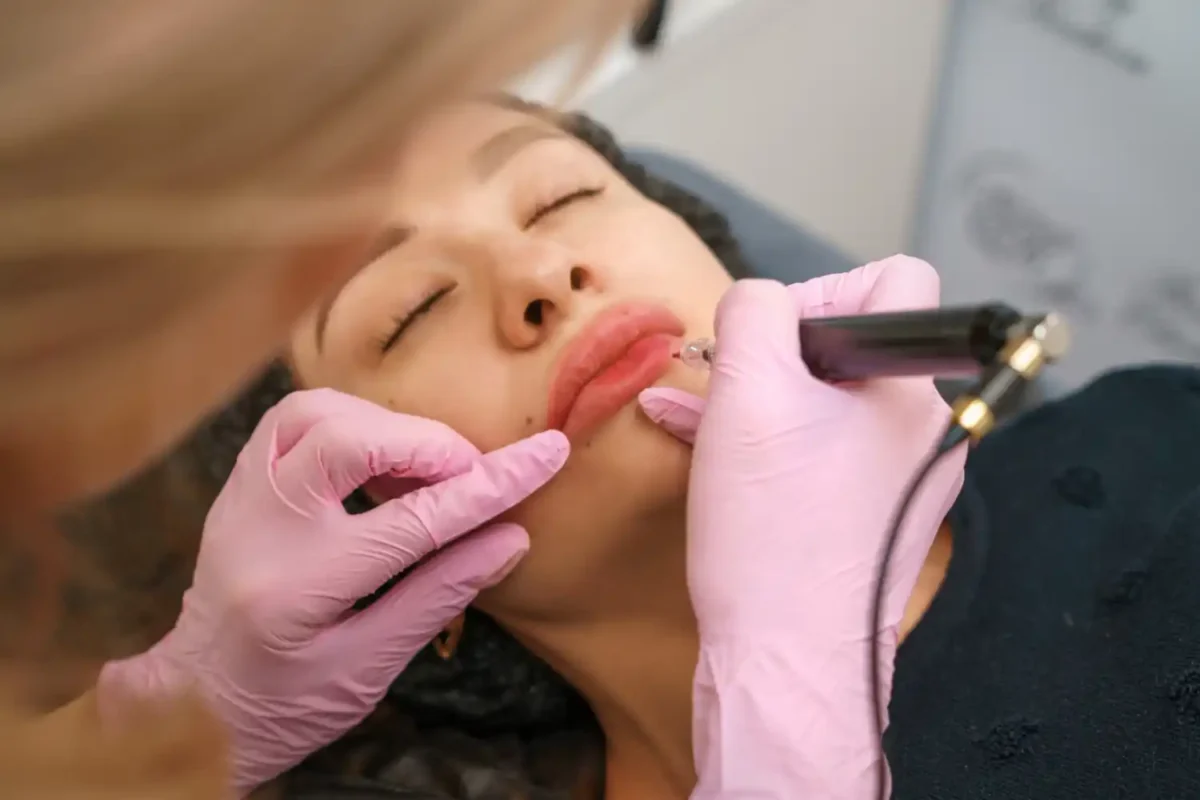 Laser treatment for sun-induced lip pigmentation