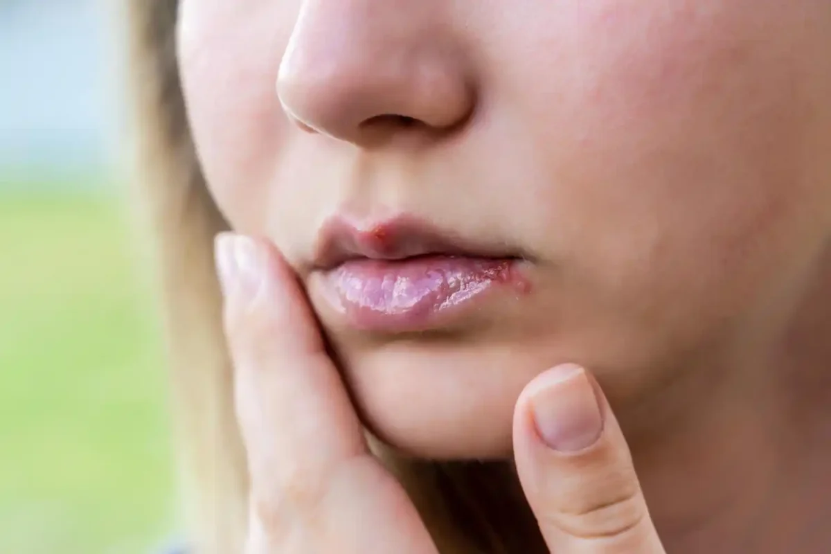 Laser treatment for smoker's lip pigmentation