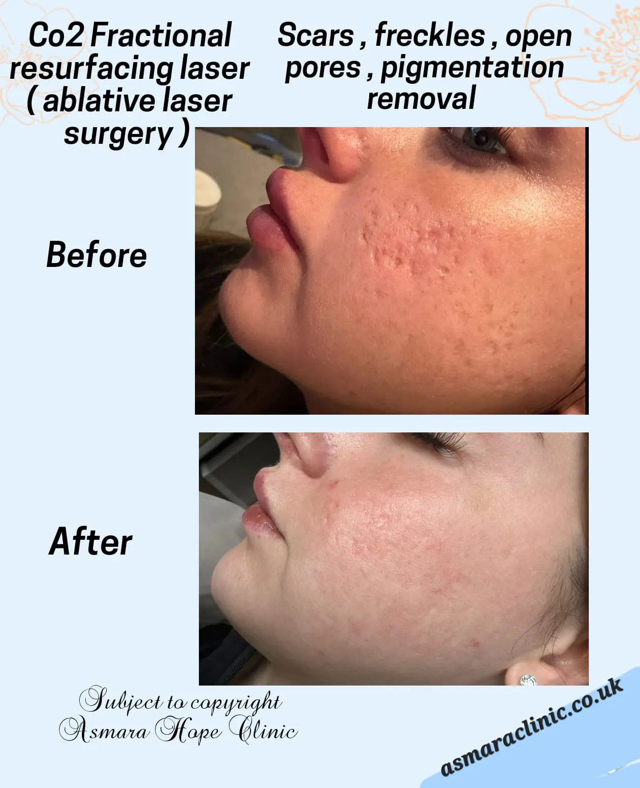 CO2 Fractional Resurfacing Laser (Ablative Laser Surgery) Scars, Freckles, Open Pores, Pigmentation Removal
